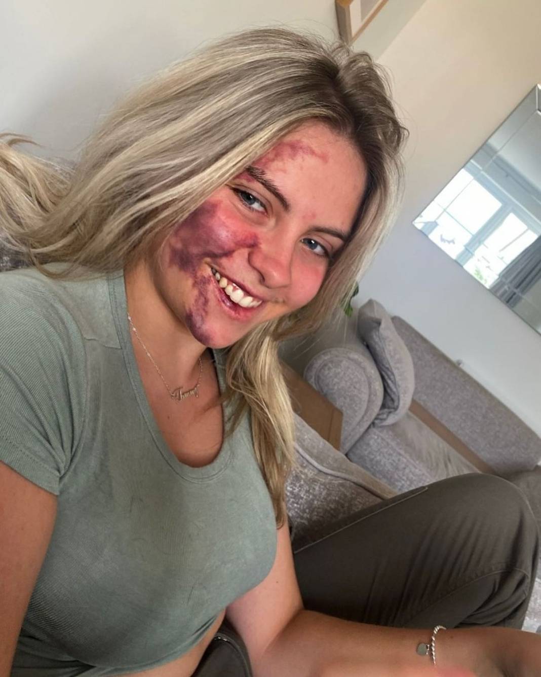 Basit bir uçuk zannetti, korkunç hastalığa yakalandı! Doktorlar bile teşhis koyamadı 10